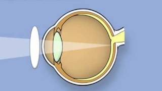 Retinoscopy of the eye Ophthalmology [upl. by Uht93]