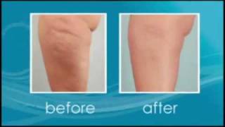 Cellulaze Cellulite Treatment Florida [upl. by Bugbee992]