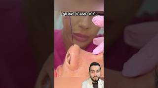 RINOPLASTIA CON HILO [upl. by Sailesh]