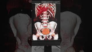 CT Urogram 3D image [upl. by Kurys]