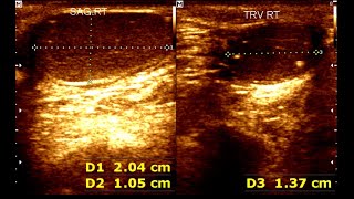 Cryptorchidism in children  Testicular Microlithiasis  Undescended testis [upl. by Nolyarg]