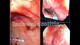 Ischemic colitis  colite ischemica [upl. by Aropizt]