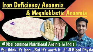 Iron Deficiency Anaemiaamp Megaloblastic AnemiaBlood PhysiologyLecturesMBBS hindi Ashish [upl. by Leimad]