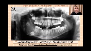 Journal Reading Dental Radiology  Calcifying Odontogenic Cyst Nurul Annisa  04074822022014 [upl. by Calvinna355]