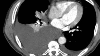 Pleural Effusions  Pathology mini tutorial [upl. by Dorry]