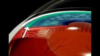 What is Glaucoma Explained using Animation [upl. by Krefetz]