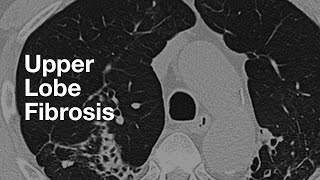 Upper Lung Predominant Fibrosis [upl. by Acimaj]