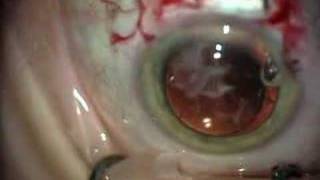 Intraocular Lens Implant [upl. by Seltzer]