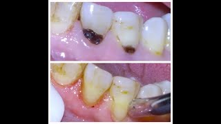 16 Repair of tooth decay at gumline [upl. by Brazee]