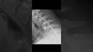 C56 disc arthroplasty xraycervicalspine [upl. by Lyman]