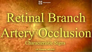 Branch Retinal Artery Occlusion Characteristic Signs [upl. by Vookles246]