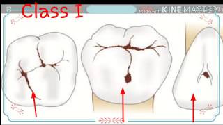 Classification of dental caries  JV Blacks Classification of dental caries [upl. by Iphigeniah822]