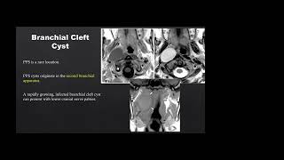 Parapharyngeal mass Dr Japneet Kaur 13 07 2023 [upl. by Clio]