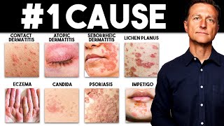 The MOST Common Deficiency in All Skin Diseases Dermatitis [upl. by Otreblaug704]