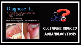 A side effect of clozapine  Agranulocytosis [upl. by Adihahs]