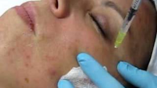 MESOTERAPIA FACIAL CON TERAPIA CELULAR [upl. by Barling]