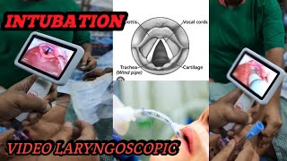 HOW TO DO VIDEO LARYNGOSCOPIC FOR TRACHEAL INTUBATION INSERT ET TUBEBENGALI LANGUAGE [upl. by Ymmaj]