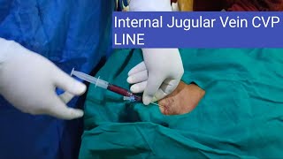 CVP line procedure through intra jugular veinenglish hospital telugu viralvideo [upl. by Docilla]