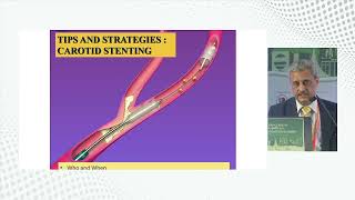 Carotid Intervention  When amp How by Dr Atul Mathur [upl. by Wyne]