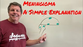 Meningioma A Simple Explanation [upl. by Link190]