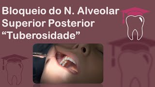 Anestesia da Tuberosidade  Bloqueio do Nervo Alveolar Superior Posterior [upl. by Anomas]