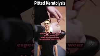 How To Get Rid of Pitted Keratolysis ONCE amp FOR ALL [upl. by Dorothea]