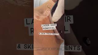 Laser Hair Removal hairremoval shortsfeed [upl. by Aneehsat]