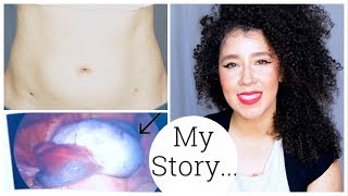 Im Back  My Ovarian Cyst Story  Ovarian Torsion  Laparoscopy Surgery [upl. by Tal]