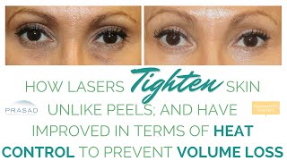 How Cosmetic Laser Treatment Can Tighten Skin and the Importance of Controlling Heat Output [upl. by Trubow]