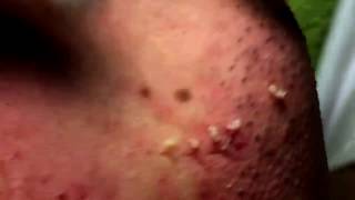 Acne Solution  Blackheads amp Whiteheads Removal 1  How to get rid of acne [upl. by Yragerg904]