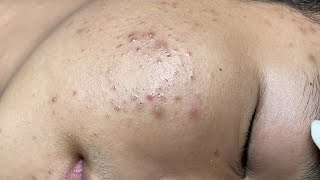 ACNE TREATMENT VU QUYNH MI  Blackheads On Boy Face 2024FULL [upl. by Reivaxe]