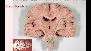 Spastic dysarthria  samples and tutorial [upl. by Seiber]