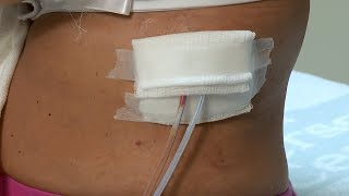 How to care for a postsurgery wound drainage system and gauze dressing [upl. by Borchers112]