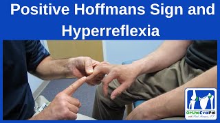 Positive Hoffmans Sign and Hyperreflexia [upl. by Dde]