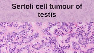 Sertoli Cell Tumour of the Testis  Pathology mini tutorial [upl. by Onitrof]