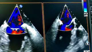 Valoración de valvulopatías mediante ecocardiograma transesofágico [upl. by Dielle]