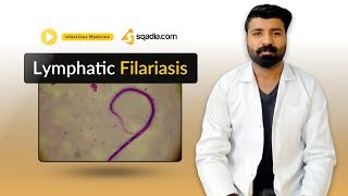 Lymphatic Filariasis  Medicine Lectures  Medical Student  VLearning  sqadiacom [upl. by Hallagan]