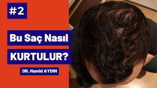 Bu Saç Nasıl Kurtulur 2 Dr Hamid AYDIN [upl. by Elane636]