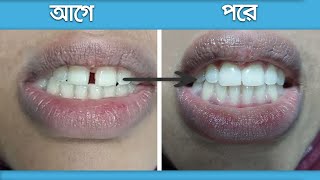 ফাঁকা দাঁতের চিকিৎসা [upl. by Noyart]