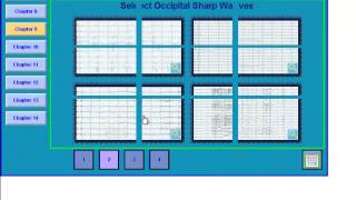 EEG in Epilepsy [upl. by Asille]