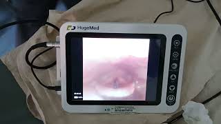 post thyroidectomy bilateral vocal cord falsy [upl. by Chandos]