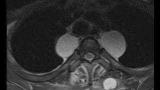 Neurofibromatosis [upl. by Wickman473]