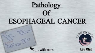 Esophageal Cancer  Adenocarcinoma  Squamous cell carcinoma  GIT Pathology [upl. by Hazel]