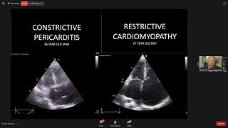 Constrictive Pericarditis amp Restrictive Cardiomyopathy Echo Update [upl. by Ridan580]