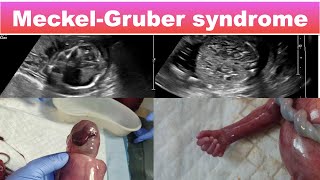 Meckel Gruber syndrome I Ultrasound [upl. by Ococ]