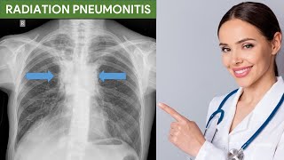 Radiation Pneumonitis [upl. by Kanal]