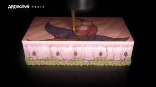 Tattoo Removal  Picoway Resolve Teaser 3D Medical Device Animation [upl. by Laohcin]