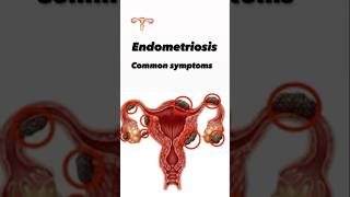 Endometriosis symptoms uterus problem womenuterine healthawarenessEndometriosis uterusproblem [upl. by Eeliab]