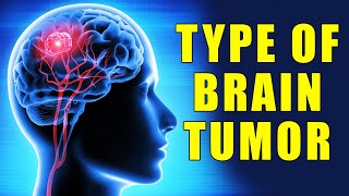 Brain Tumor New Therapeutic Possibilities  Innovative Approaches to Treating Brain Tumors [upl. by Lord300]