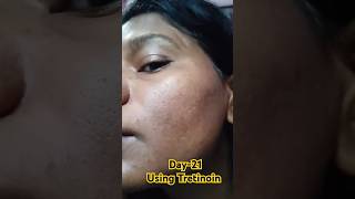 Day21 Using Tretinoin 0025 cream viralvideo tretinoin shorts skincare youtubeshorts [upl. by Ainaznat]